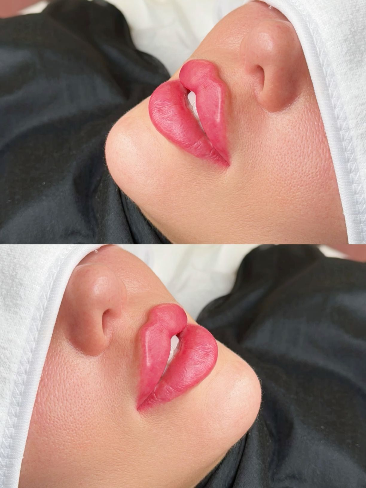 تزریق فیلر و مادلینگ تخصصی توسط پزشک